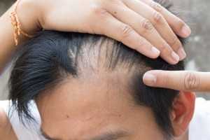 Hair Loss Treatment in Michigan