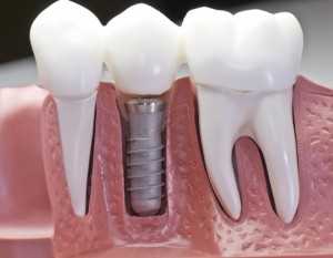 Dental Implant Surgery Model