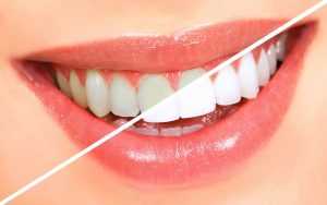 Teeth Whitening Myths in Glenview