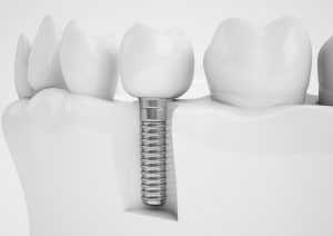 Dental implant concept